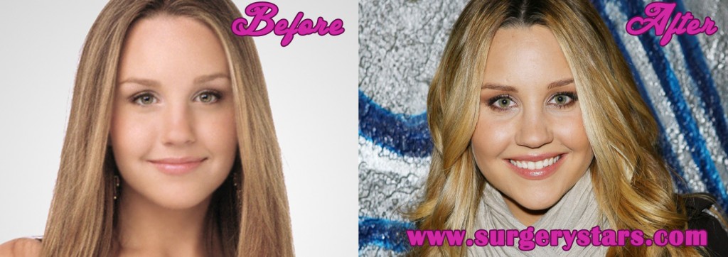 Amanda Bynes Plastic Surgery Before After Photos