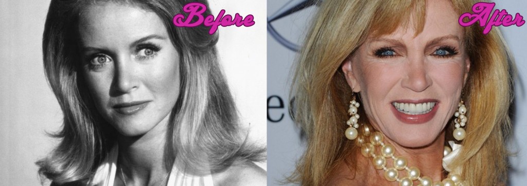 Donna Mills Before and After Surgery Pics | Surgery Stars