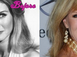 Donna Mills Before and After Surgery Pics