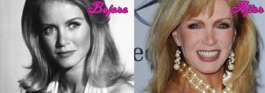 Donna Mills Before and After Surgery Pics