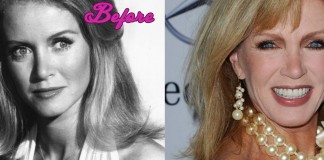 Donna Mills Before and After Surgery Pics