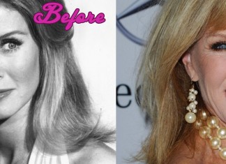 Donna Mills Before and After Surgery Pics