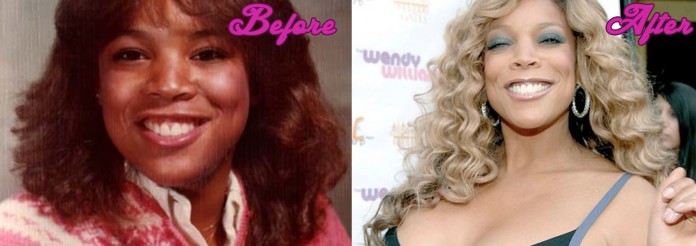 Wendy Williams Plastic Surgery Before and After