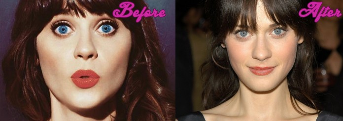 Zooey Deschanel Before and After Surgery Pictures