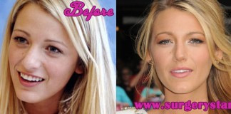 blake lively before and after nose jobl