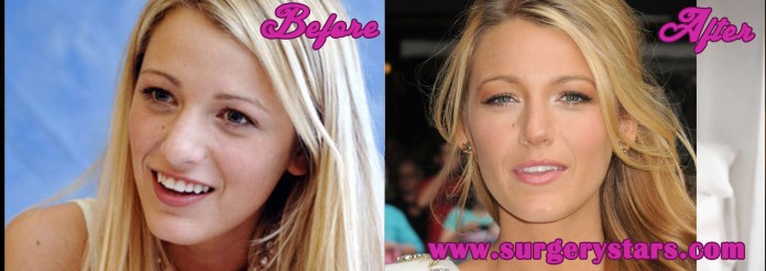 blake lively before and after nose jobl