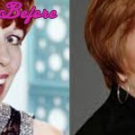 Carol Burnett plastic surgery - Before and After Pictures