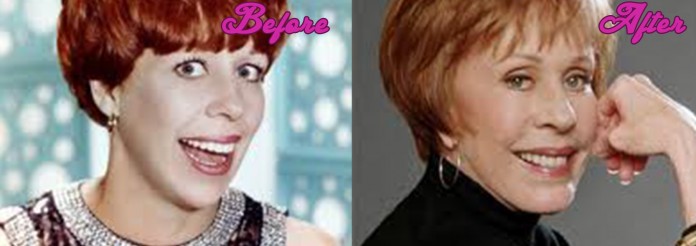 Carol Burnett plastic surgery - Before and After Pictures