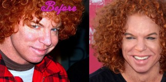 Carrot Top Before and After Cosmetic Surgery Pics