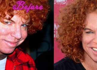 Carrot Top Before and After Cosmetic Surgery Pics