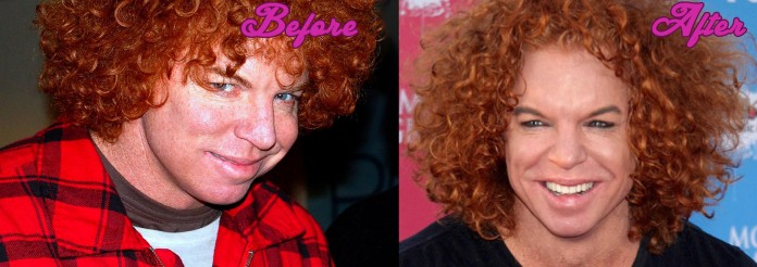 Carrot Top Before and After Cosmetic Surgery Pics