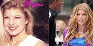 Fergie Plastic Surgery Pictures