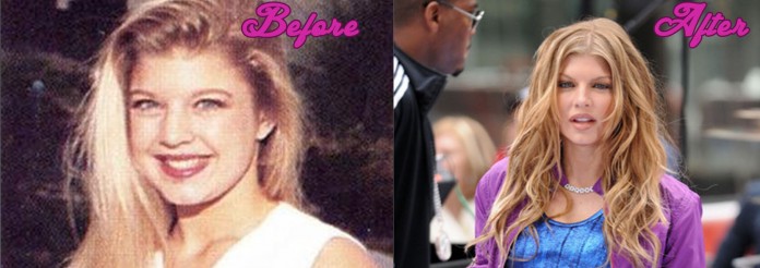 Fergie Plastic Surgery Pictures