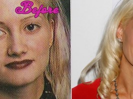 Holly Madison Plastic Surgery Pictures