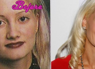 Holly Madison Plastic Surgery Pictures