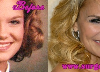 Kristin Chenoweth Plastic surgeries Before and After