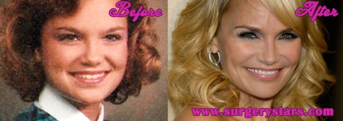Kristin Chenoweth Plastic surgeries Before and After