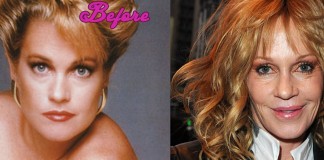 Melanie Griffith's Plastic Surgery Mistakes Pictures