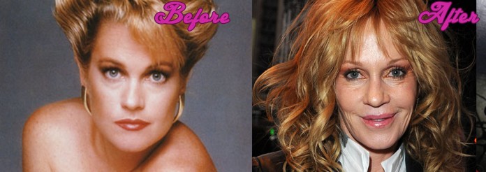Melanie Griffith's Plastic Surgery Mistakes Pictures