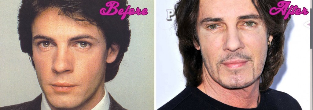 Rick Springfield Plastic Surgery Before and After Pictures 