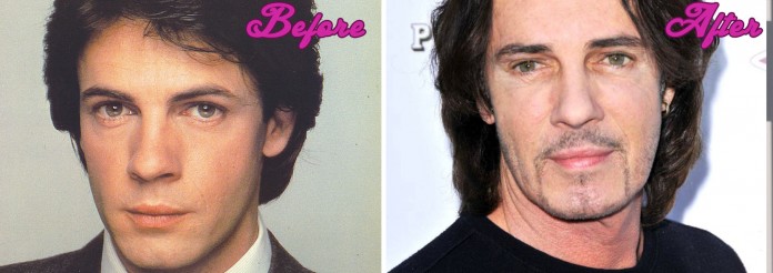 Rick Springfield Plastic Surgery Before and After Pictures