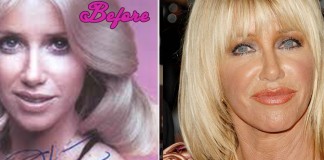 Did Suzanne Somers Have Plastic Surgery?