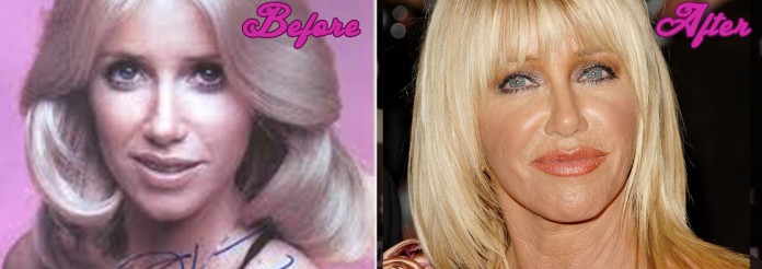 Did Suzanne Somers Have Plastic Surgery?
