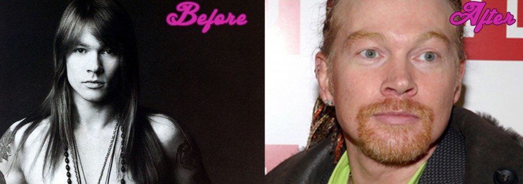 The Axl Rose Plastic Surgery - Celebrity Makeover 