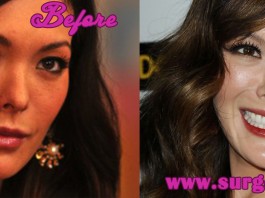 Lindsay Price Plastic Surgery