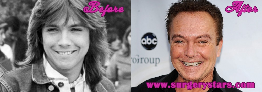 David Cassidy Before and After Plastic  Surgery 