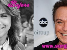 David Cassidy Before and After Plastic Surgery