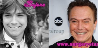 David Cassidy Before and After Plastic Surgery