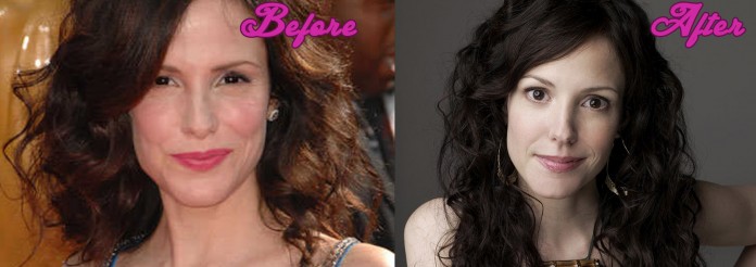 Mary Louise Parker Plastic Surgery Pics