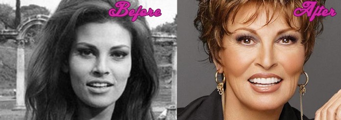 Raquel Welch Plastic Surgery Pics