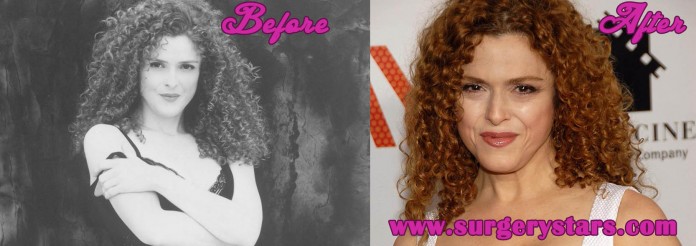 Bernadette Peters sugery pictures