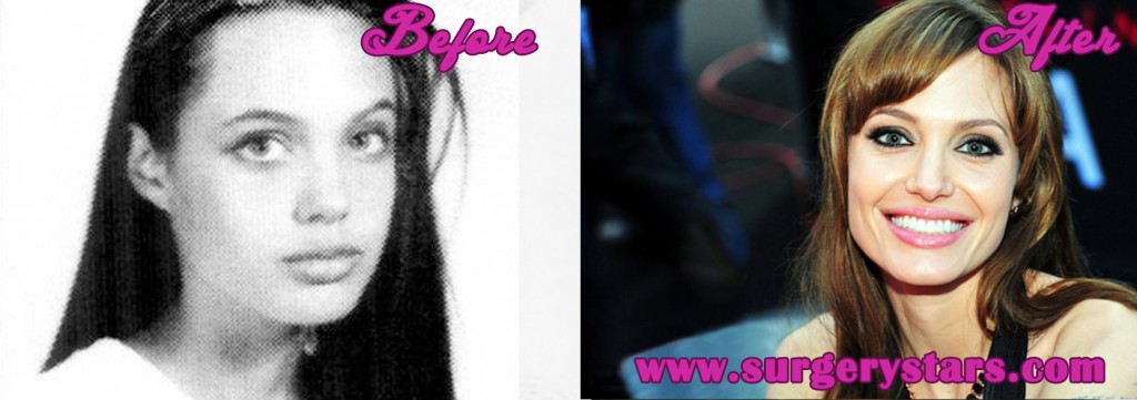 Angelina Jolie Plastic Surgery Before and After Pics
