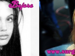 Angelina Jolie Plastic Surgery Before and After Pics