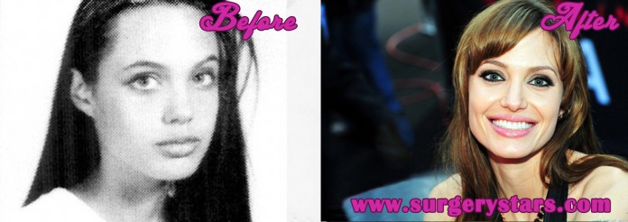 Angelina Jolie Plastic Surgery Before and After Pics