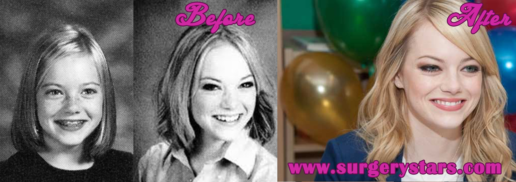 Emma Stone Plastic Surgery - Before and After Shoots