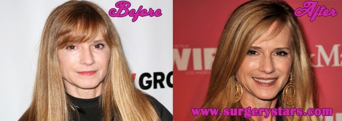 holly hunter plastic surgery