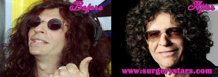 howard stern plastic surgery