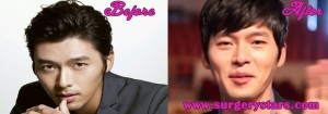 hyun bin plastic surgery