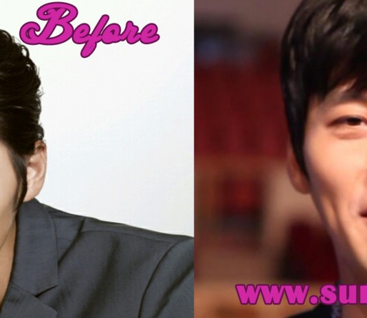 hyun bin plastic surgery