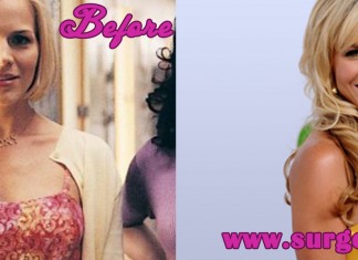 julie benz before and after sugery