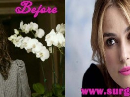 keira knightley plastic surgery