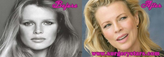 kim basinger plastic surgery