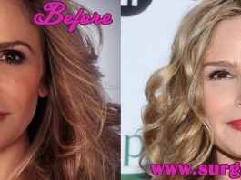 kyra sedgwick plastic surgery