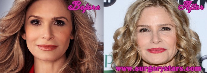 kyra sedgwick plastic surgery