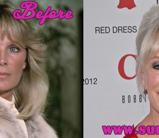 linda evans plastic surgery