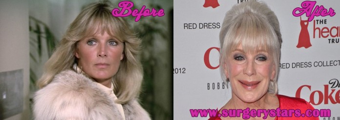 linda evans plastic surgery